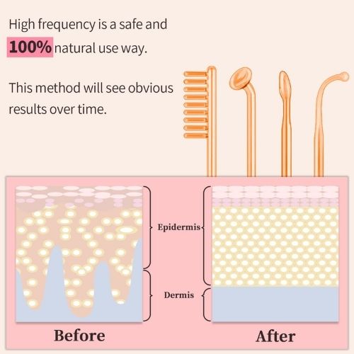 High Frequency Facial Wand | 4-in-1 Electrotherapy Skin & Hair Care Device